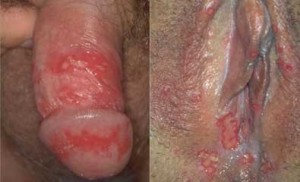 Illustration for article titled Obat Penyakit Herpes Kelamin